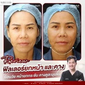 รีวิวฟิลเลอร์ปรับรูปหน้า บ้านหมี คลินิก